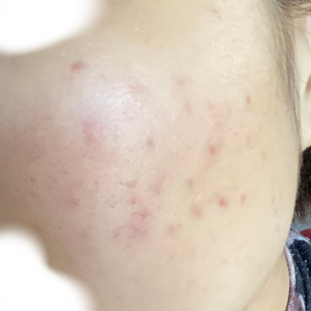 K on LIPS 「12/23~2/1までの経過12/23~1/10べピオゲル1/..」(7枚目)