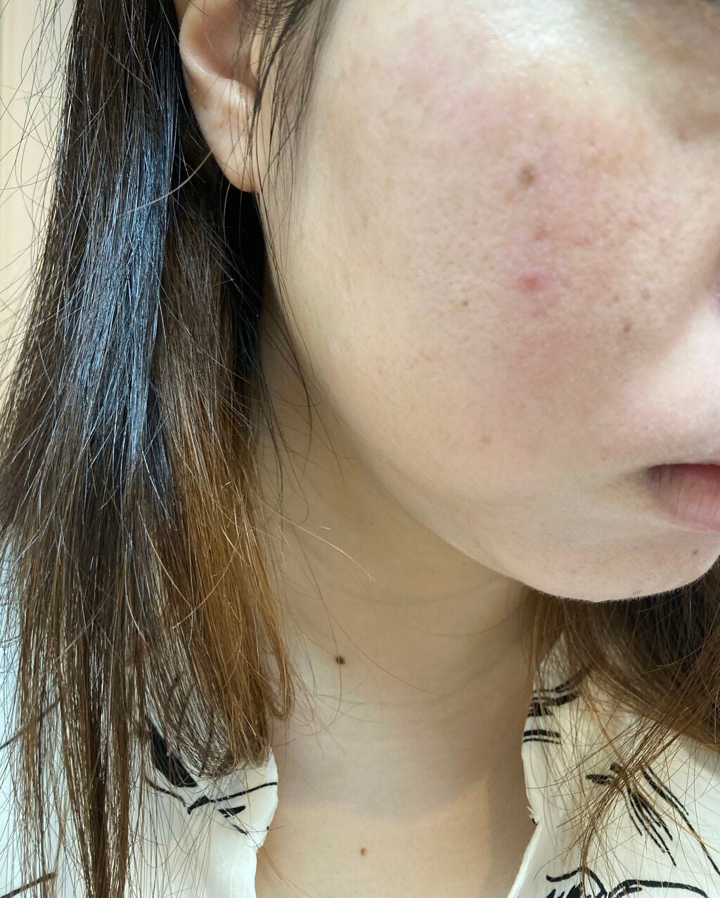 しい on LIPS 「カソーダ9日目特に変わりなし。皮向けもないし赤みもそれほど、、..」(2枚目)