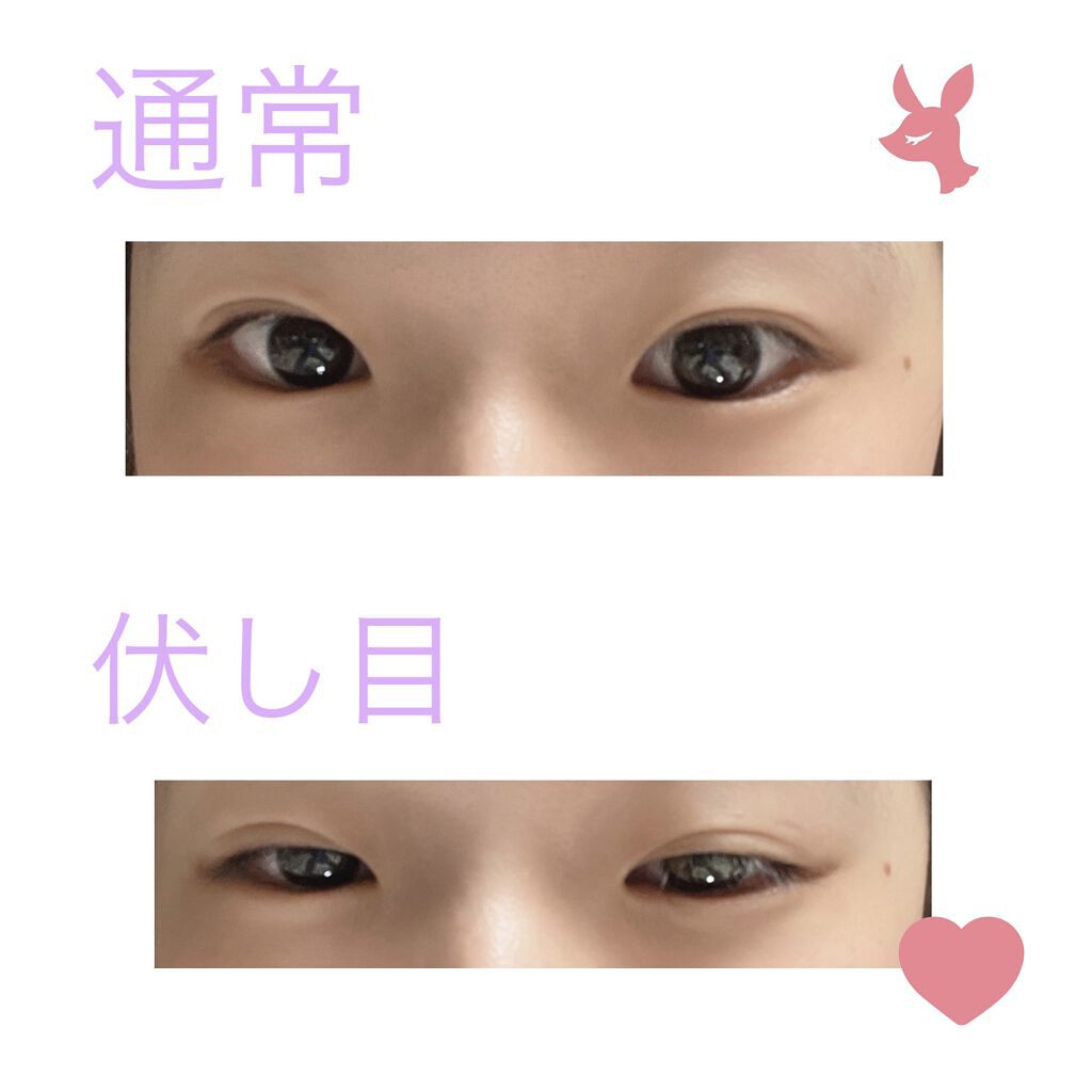 二重整形/その他を使ったクチコミ（2枚目）