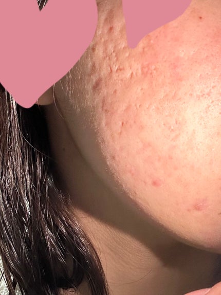 ミネラルBBパウダー EM(エンリッチモイスト)/毛穴パテ職人/プレストパウダーを使ったクチコミ(2枚目)