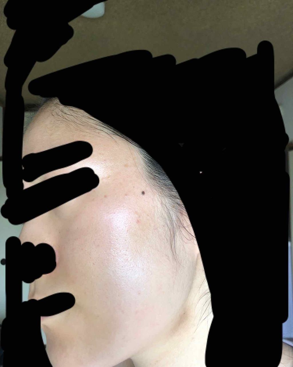 スキンピールバー ハイドロキノール/サンソリット/洗顔石鹸を使ったクチコミ（3枚目）