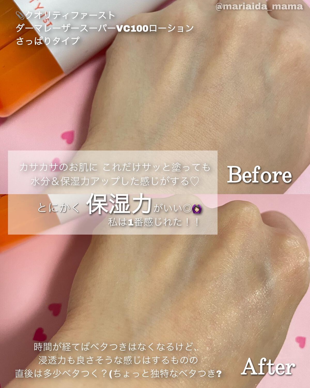 ダーマレーザー スーパーVC100ローション(さっぱり)/クオリティファースト/化粧水を使ったクチコミ(5枚目)