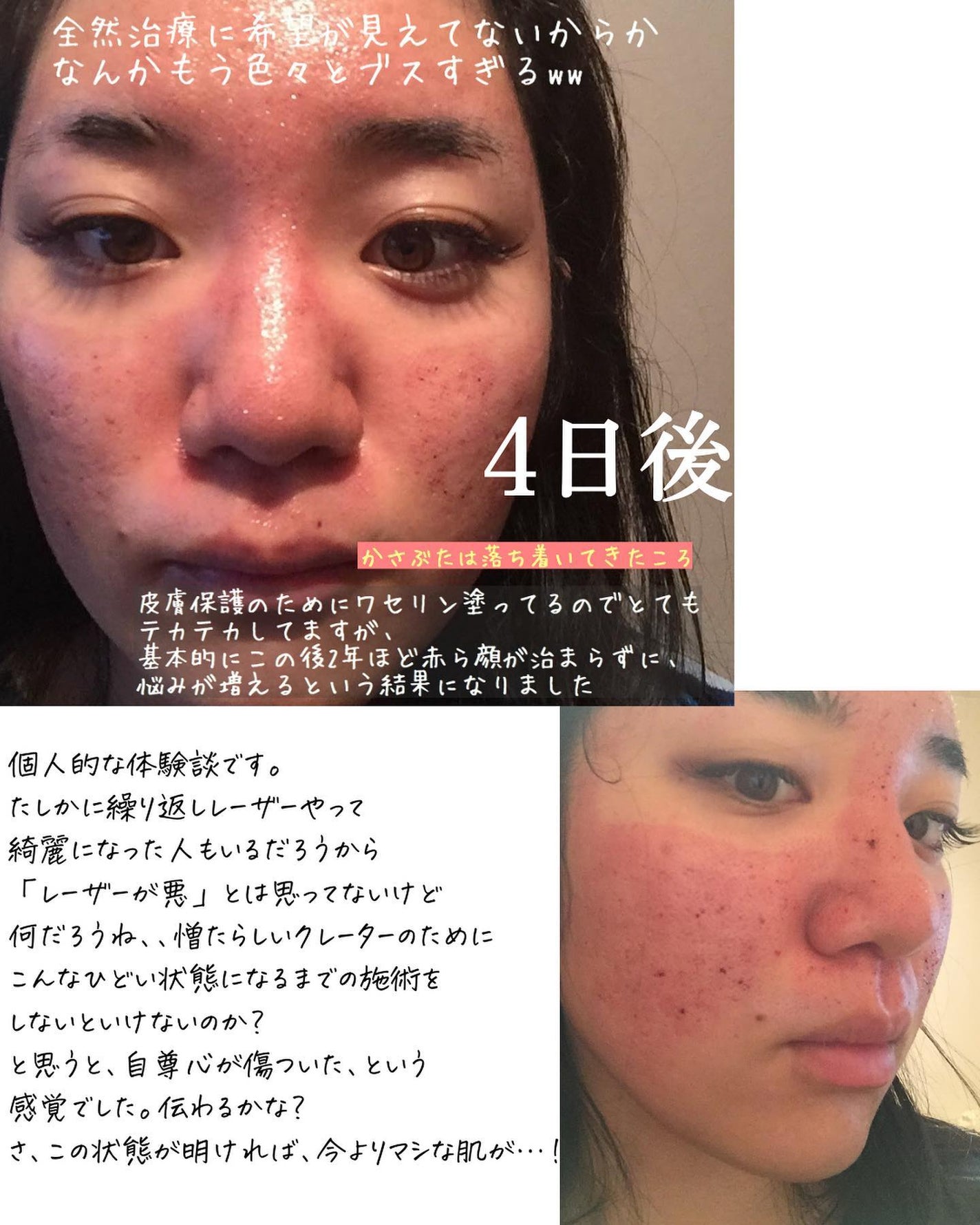 おゆみ|ニキビ・ニキビ跡ケア on LIPS 「【しくじり先生②早まるな、肌爆撃!💣】こんばんは、おゆみです💁..」(6枚目)