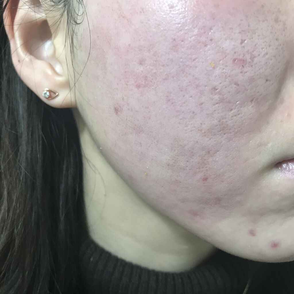 コラーゲン インパクト エッセンシャルマスクEX/MEDIHEAL/シートマスク・パックを使ったクチコミ（2枚目）