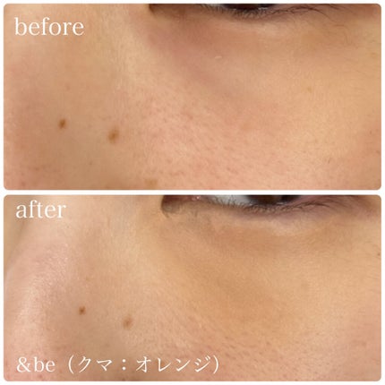 【旧】ディオールスキン フォーエヴァー スキン コレクト コンシーラー/Dior/リキッドコンシーラーを使ったクチコミ(6枚目)