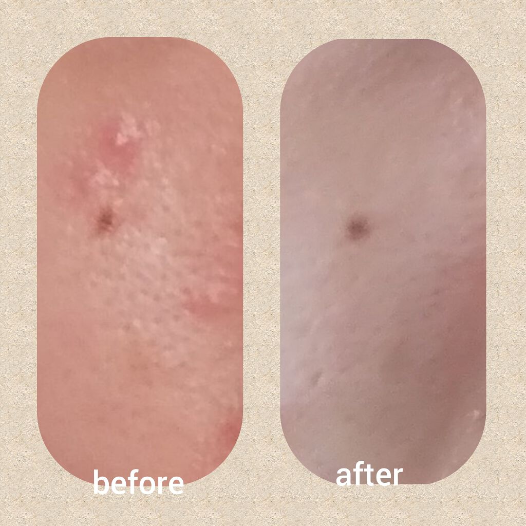 トラブルリペア リキッド/アルージェ/美容液を使ったクチコミ(2枚目)