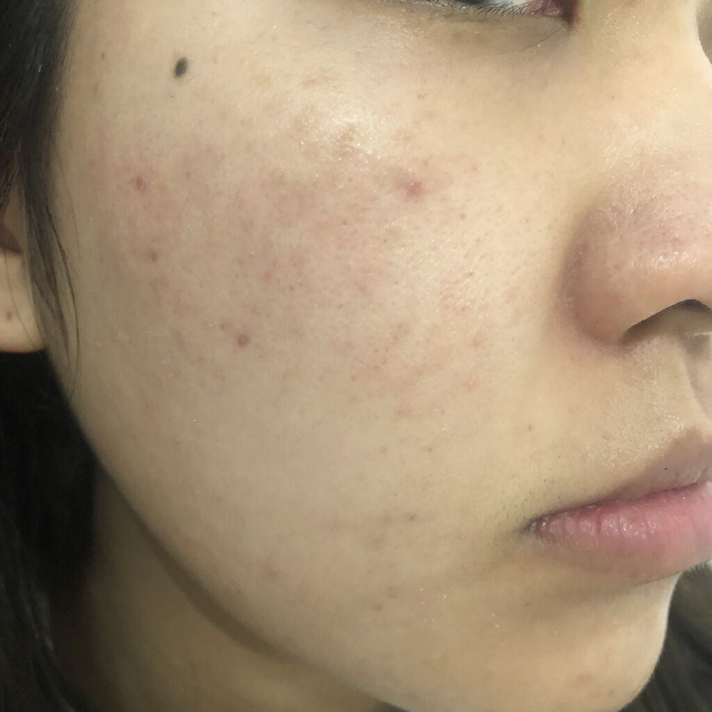 薬用 しみ 集中対策 美容液/メラノCC/美容液を使ったクチコミ（2枚目）