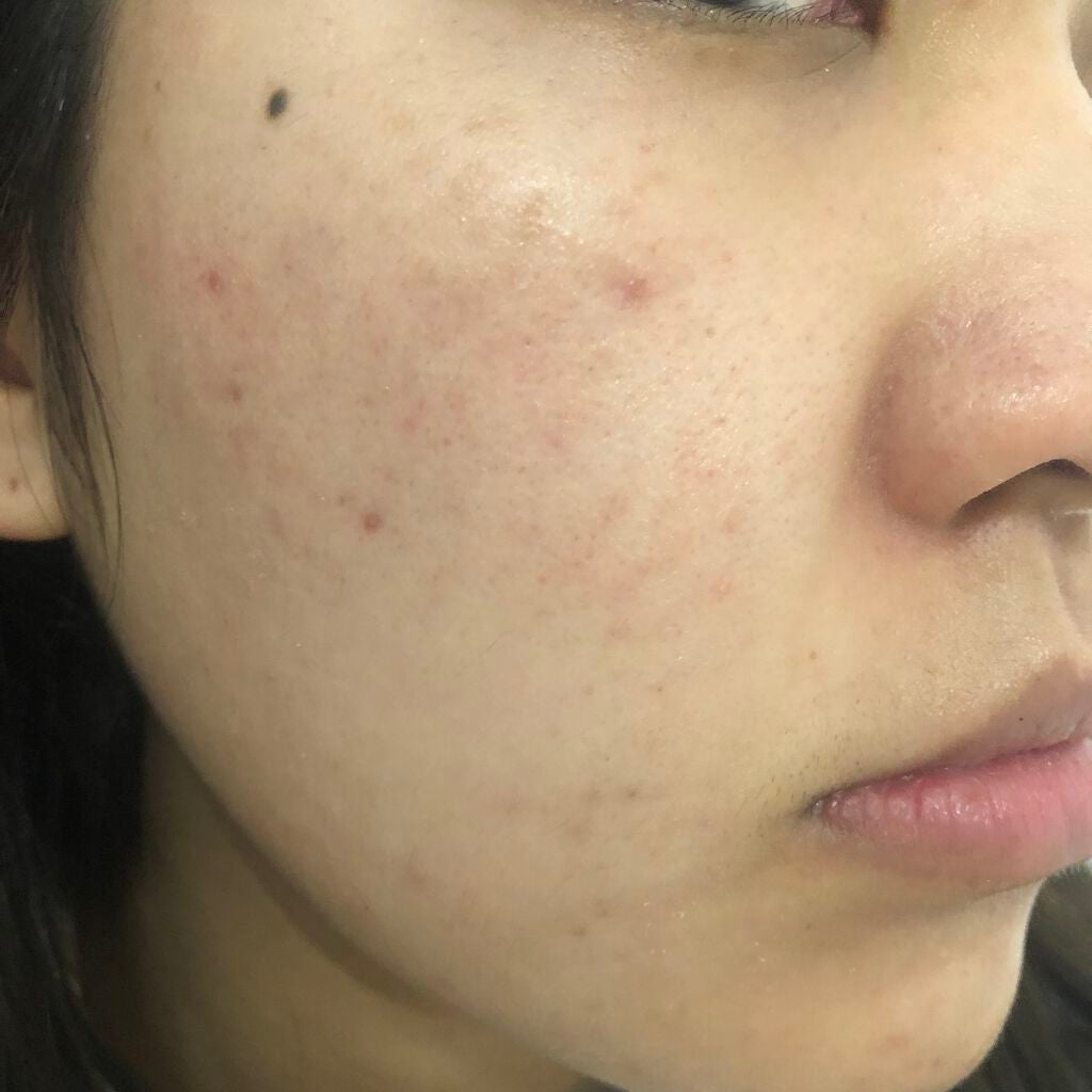 薬用 しみ 集中対策 美容液/メラノCC/美容液を使ったクチコミ(2枚目)