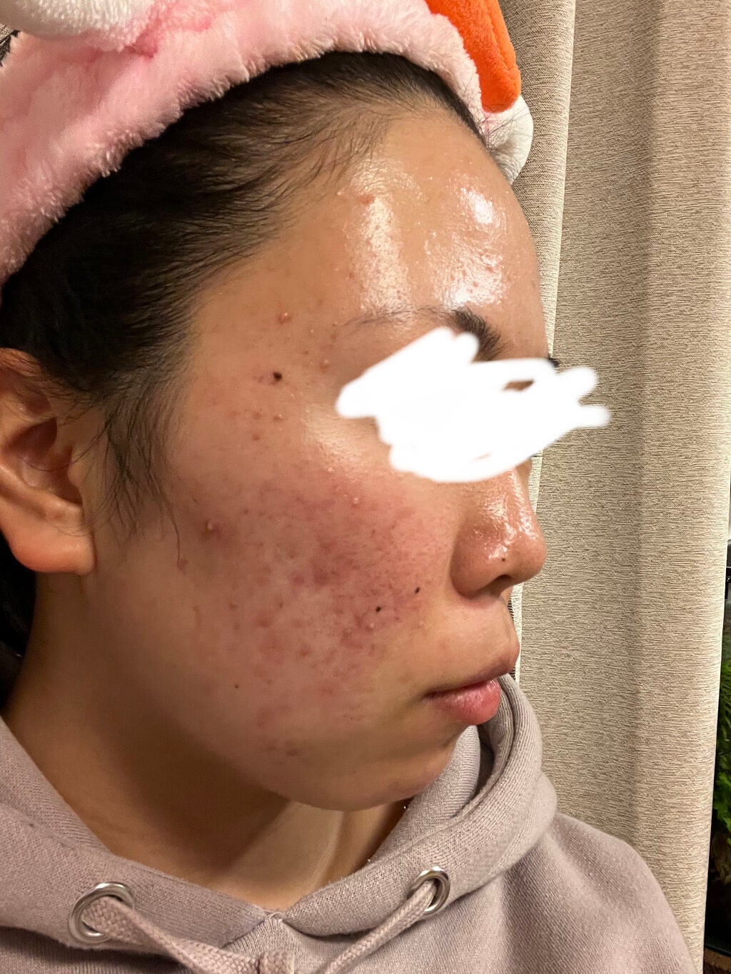 じゃがりこ@サラダ on LIPS 「お久しぶりです。今日は私が皮膚科に行った時の話をしたいと思いま..」(2枚目)