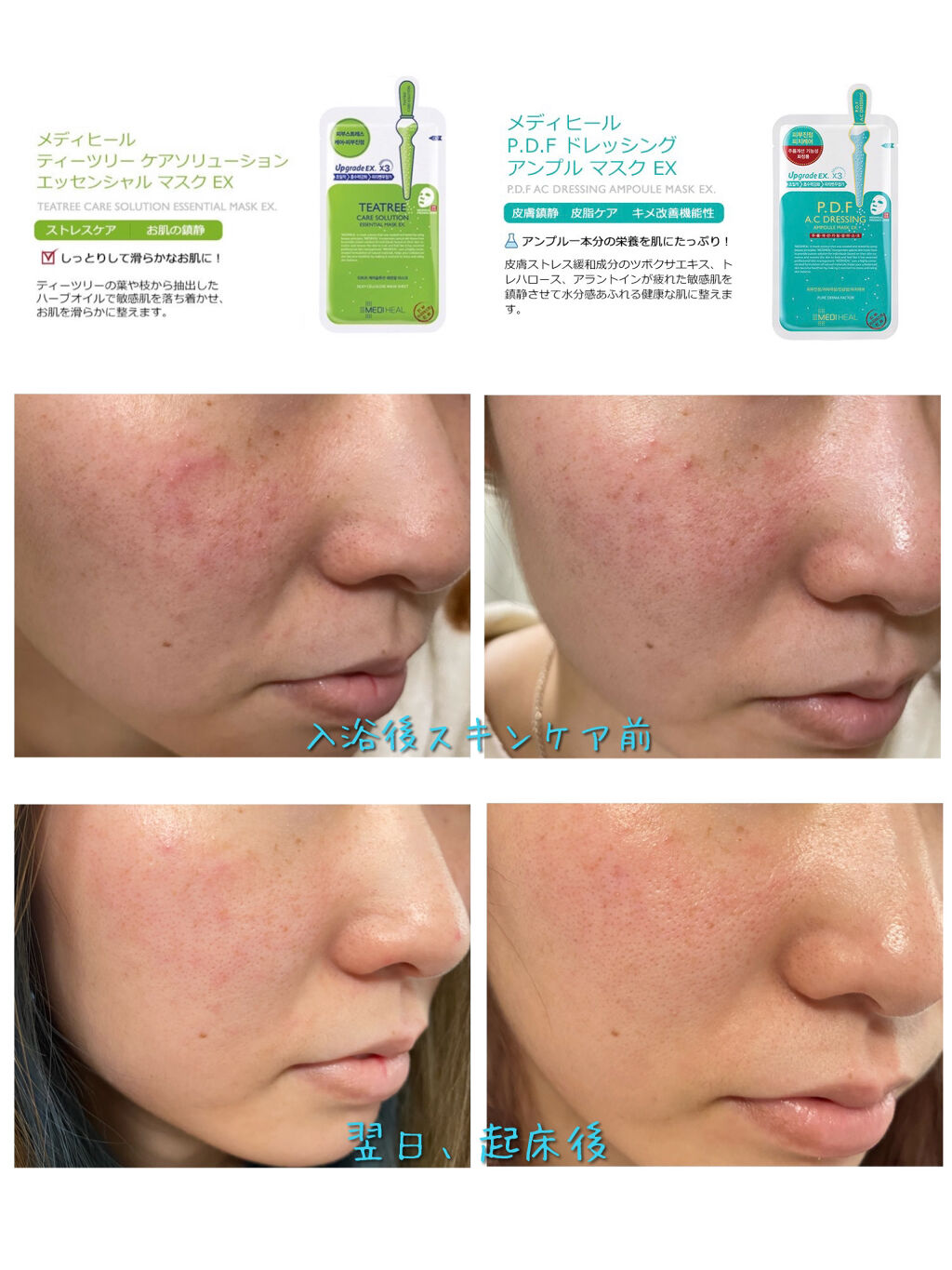 P.D.F A.Cドレッシングアンプルマスク EX/MEDIHEAL/シートマスク・パックを使ったクチコミ（2枚目）