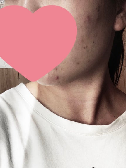 オードムーゲ 薬用ローション(ふきとり化粧水)/オードムーゲ/拭き取り化粧水を使ったクチコミ(2枚目)