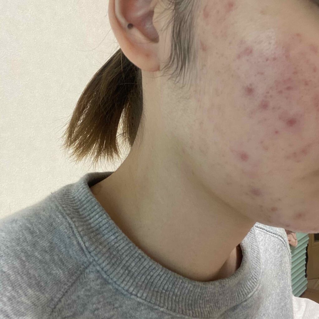 ゆうか on LIPS 「お肌日記まだ効果はでてない🤧10.27..」(1枚目)