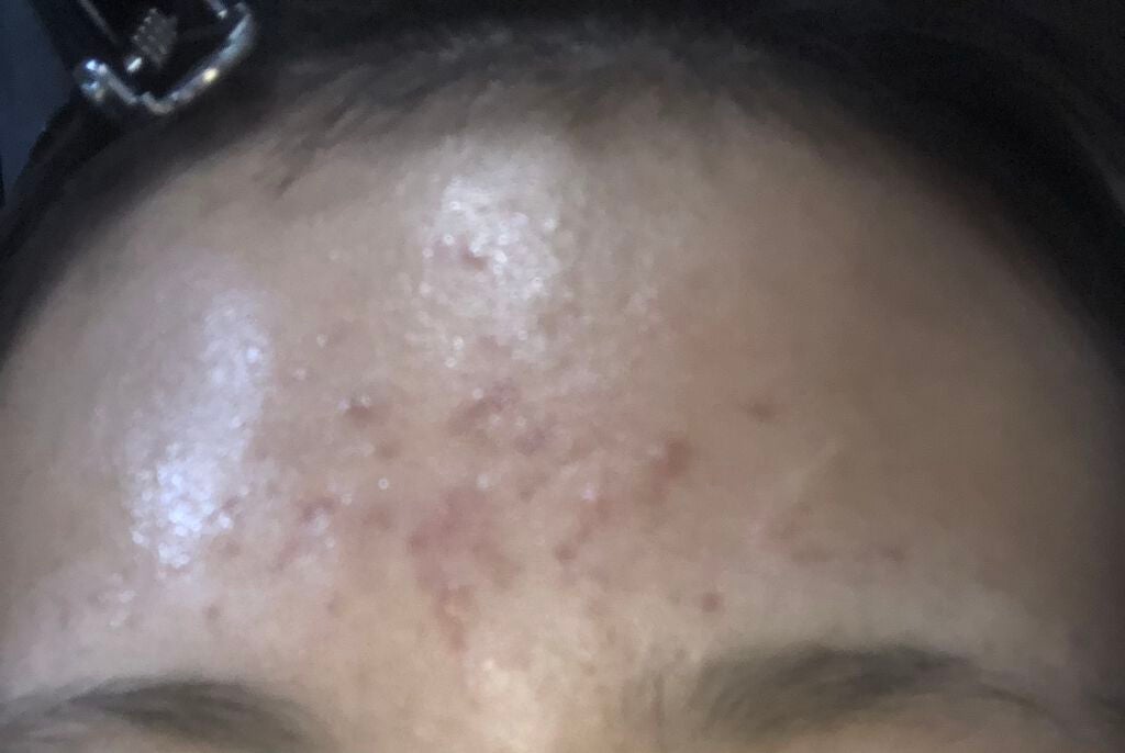 ❤︎𝐑𝐄𝐈𝐊𝐀❤︎ on LIPS 「最近ニキビに大変悩んでいます。私はニキビが出来たらすぐ潰してし..」(3枚目)