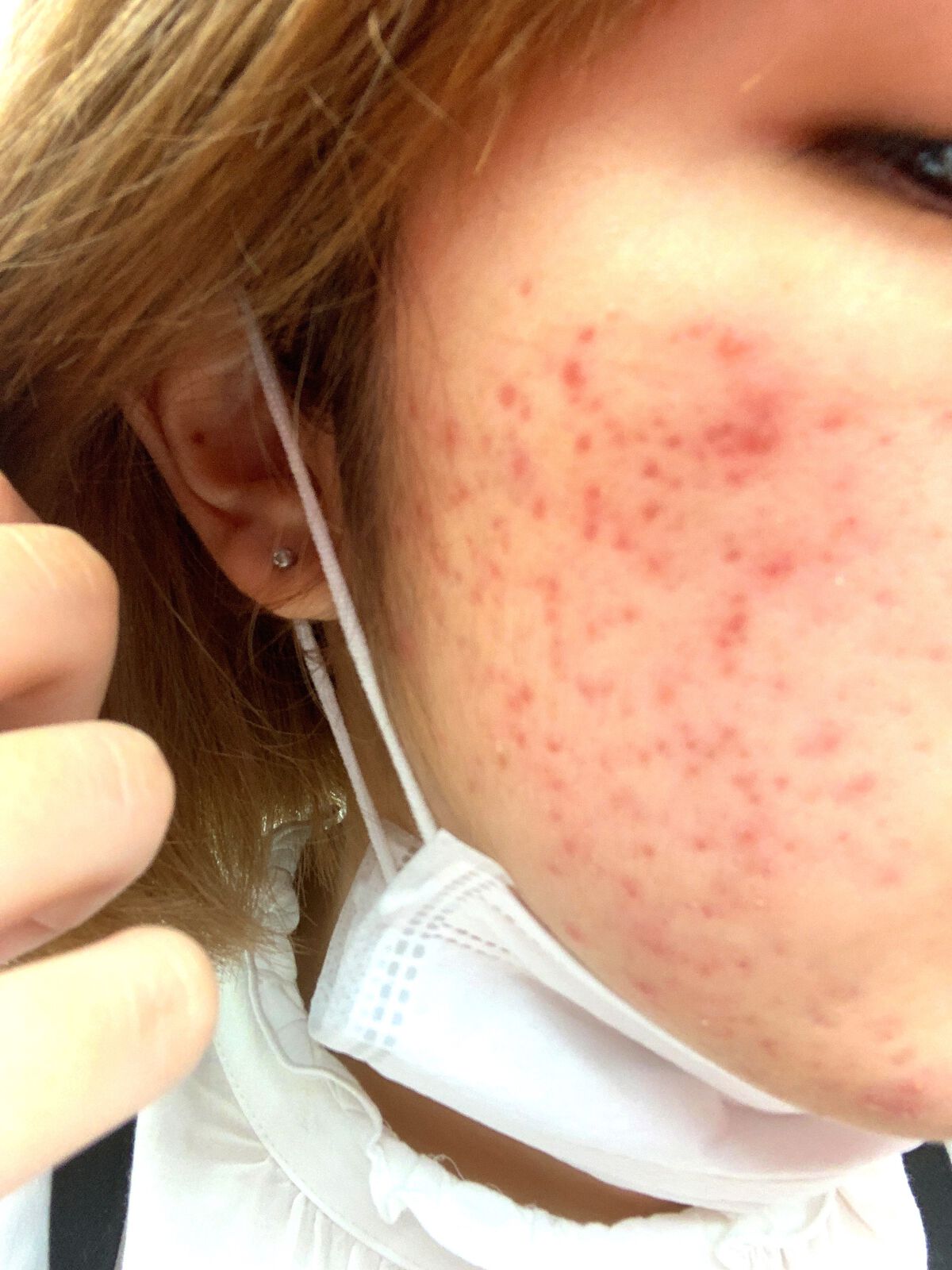 ニキビ跡消えろ on LIPS 「8月22日ニキビ跡日記⚠️2枚目閲覧注意#ニキビ#ニキビ跡#ベ..」(2枚目)