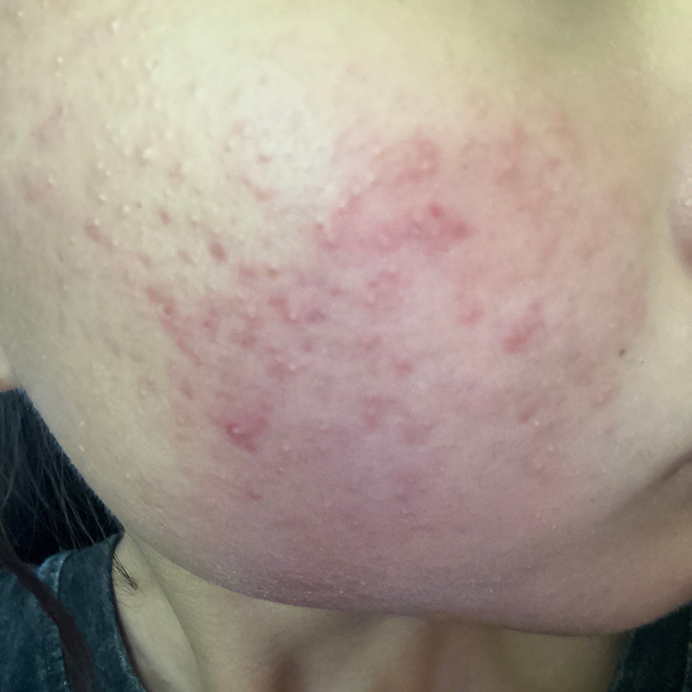 ペアアクネクリームW(医薬品)/ペア/その他を使ったクチコミ(1枚目)