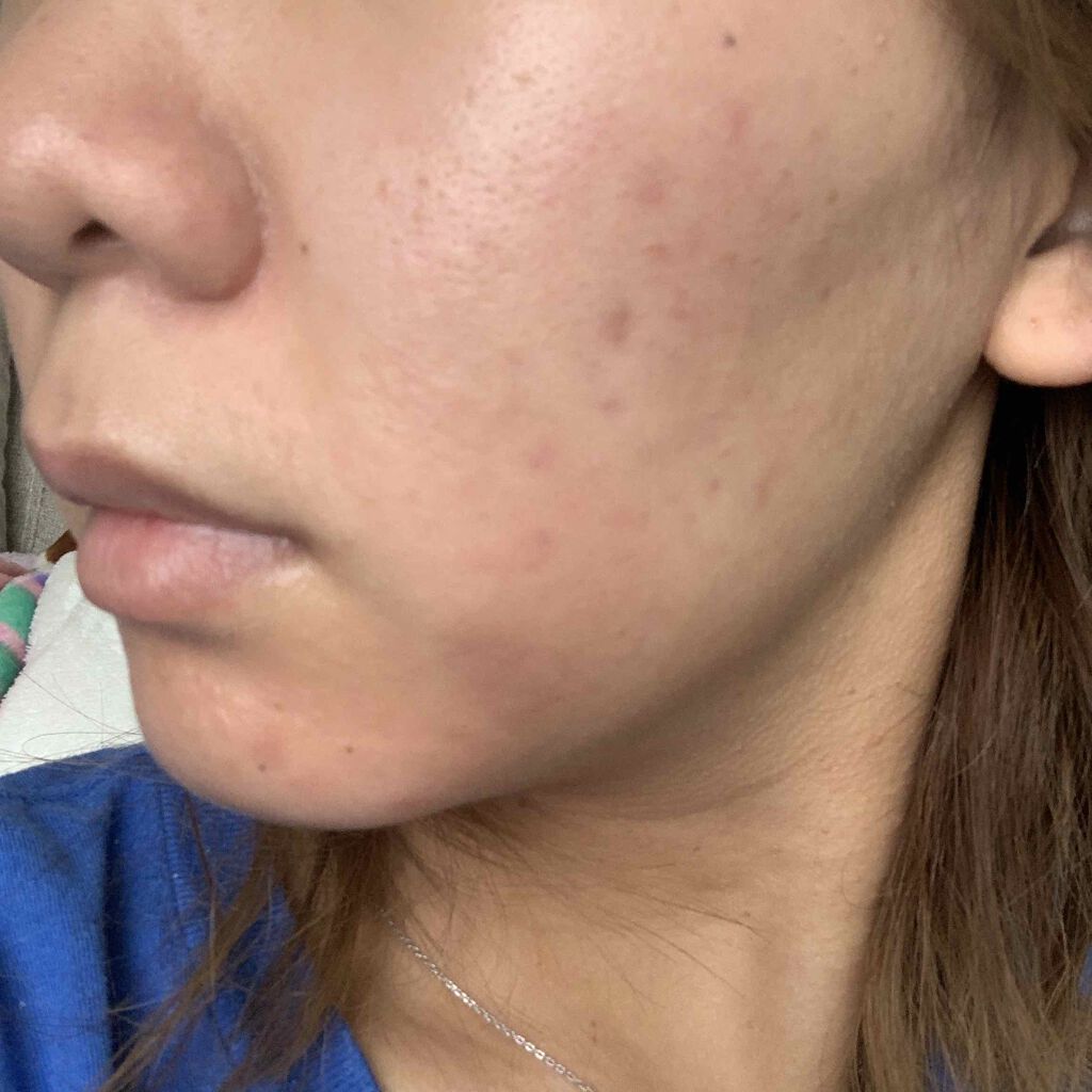 ゆる子 on LIPS 「べピオ14日目🥶肌の凸凹が少なくなってきた。#ベピオゲル..」(2枚目)