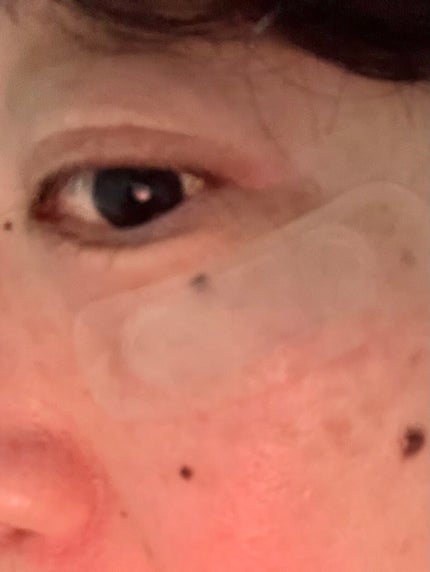 W+ マイクロ ニードル パッチ/SNP/アイケア・アイクリームを使ったクチコミ(3枚目)