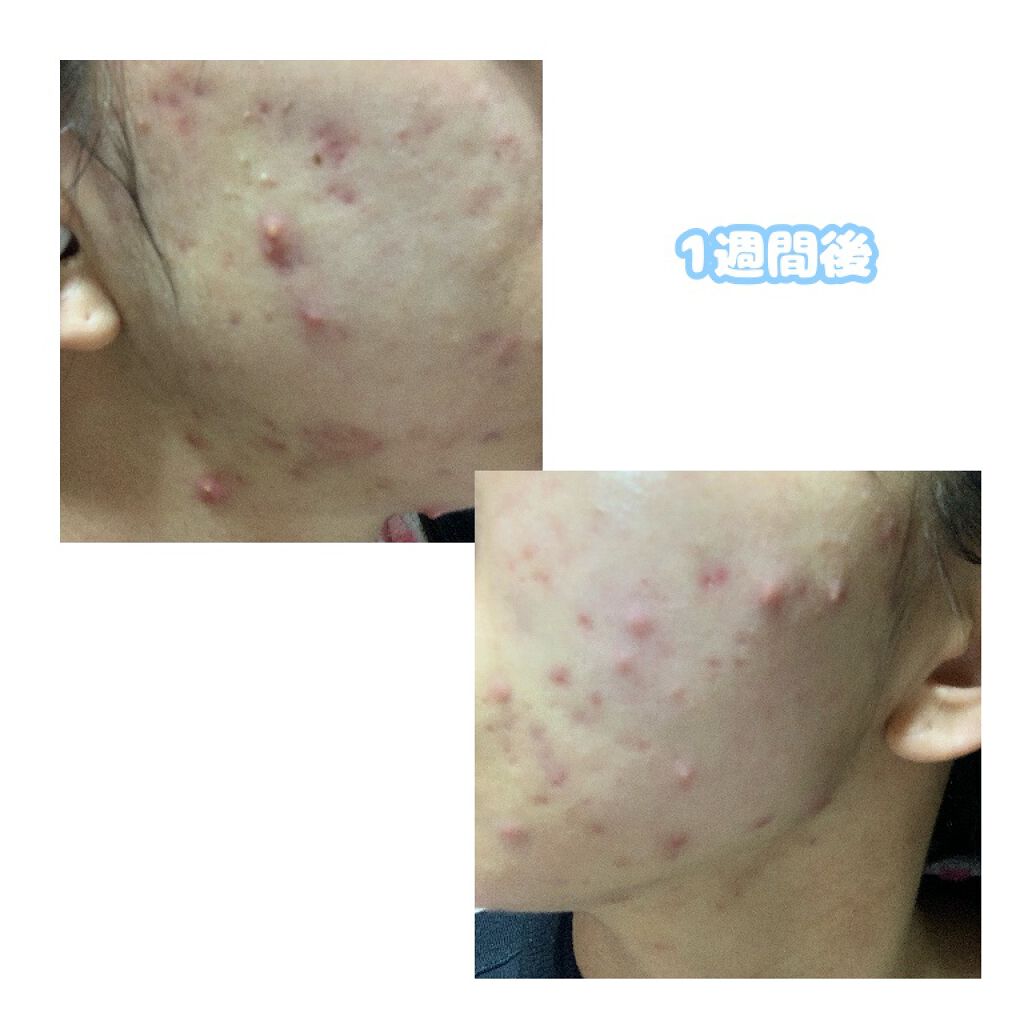 敏感肌用薬用美白美容液/無印良品/美容液を使ったクチコミ(8枚目)