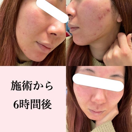 aiko on LIPS 「⚠️写真も真っ赤な肌が出てきます😣しかも写真の撮り方めっちゃ下..」(3枚目)