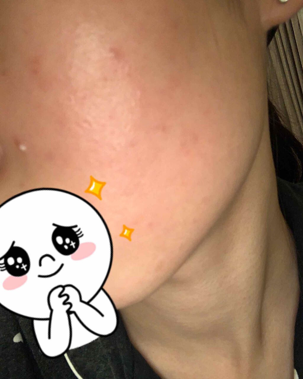 ペアアクネクリームW(医薬品)/ペア/その他を使ったクチコミ（2枚目）