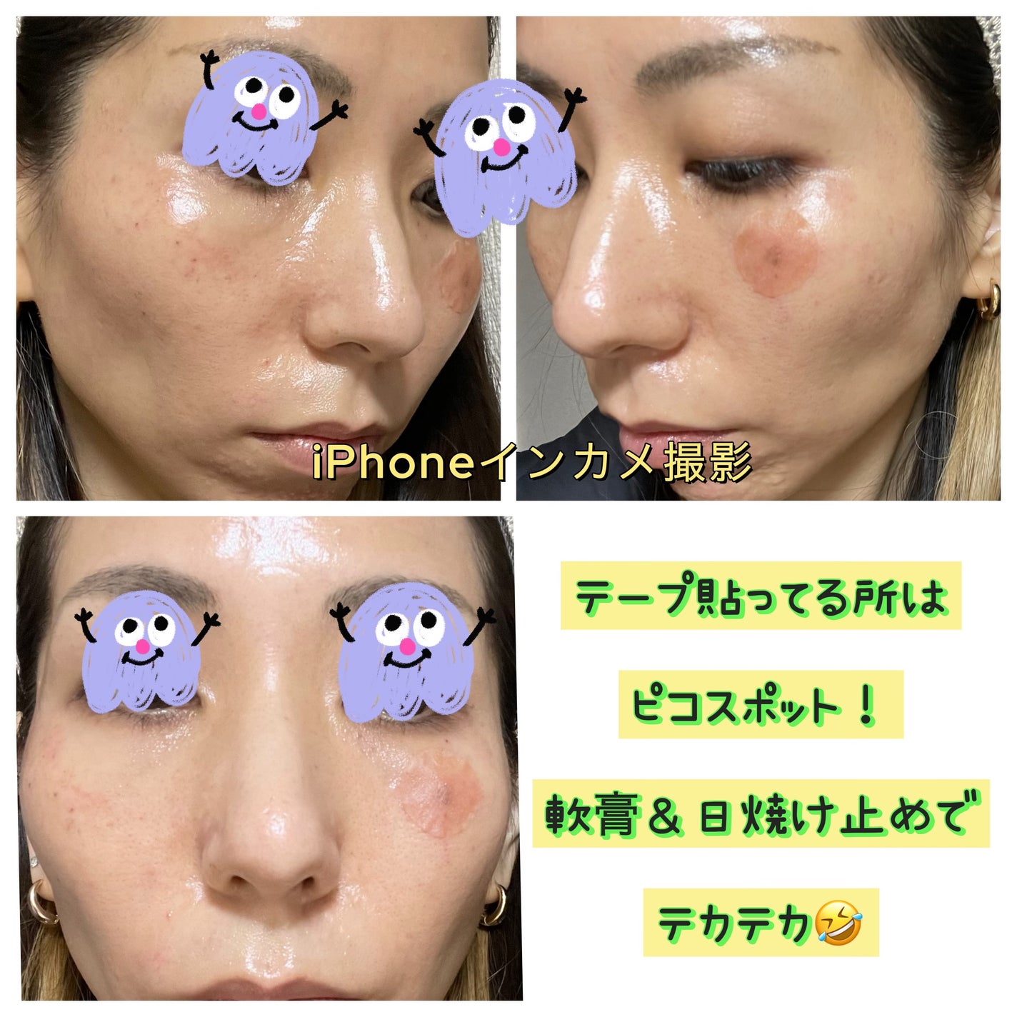 汚肌ママン on LIPS 「美容医療の経過残してくー✍️写真は施術後2時間程☆顔脱毛の感想..」(2枚目)