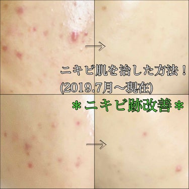 Kiehl's キールズ DS クリアリーブライト エッセンス[医薬部外品]のクチコミ「ニキビ跡編！

あくまでも肌荒れが落ち着いてからの
ニキビ跡対策なので
荒れてる肌には基礎編を.....」（1枚目）