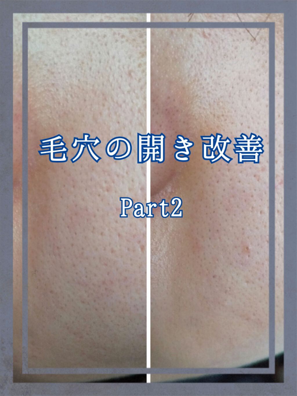 光美容器KE-NON（ケノン）/エムテック/家庭用脱毛器を使ったクチコミ（1枚目）