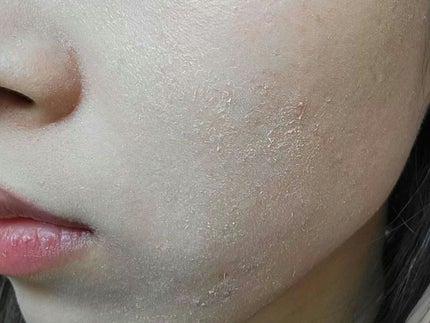 レチノールA 1% アドバンスドリバイタリゼーションクリーム/Life-flo/フェイスクリームを使ったクチコミ(6枚目)