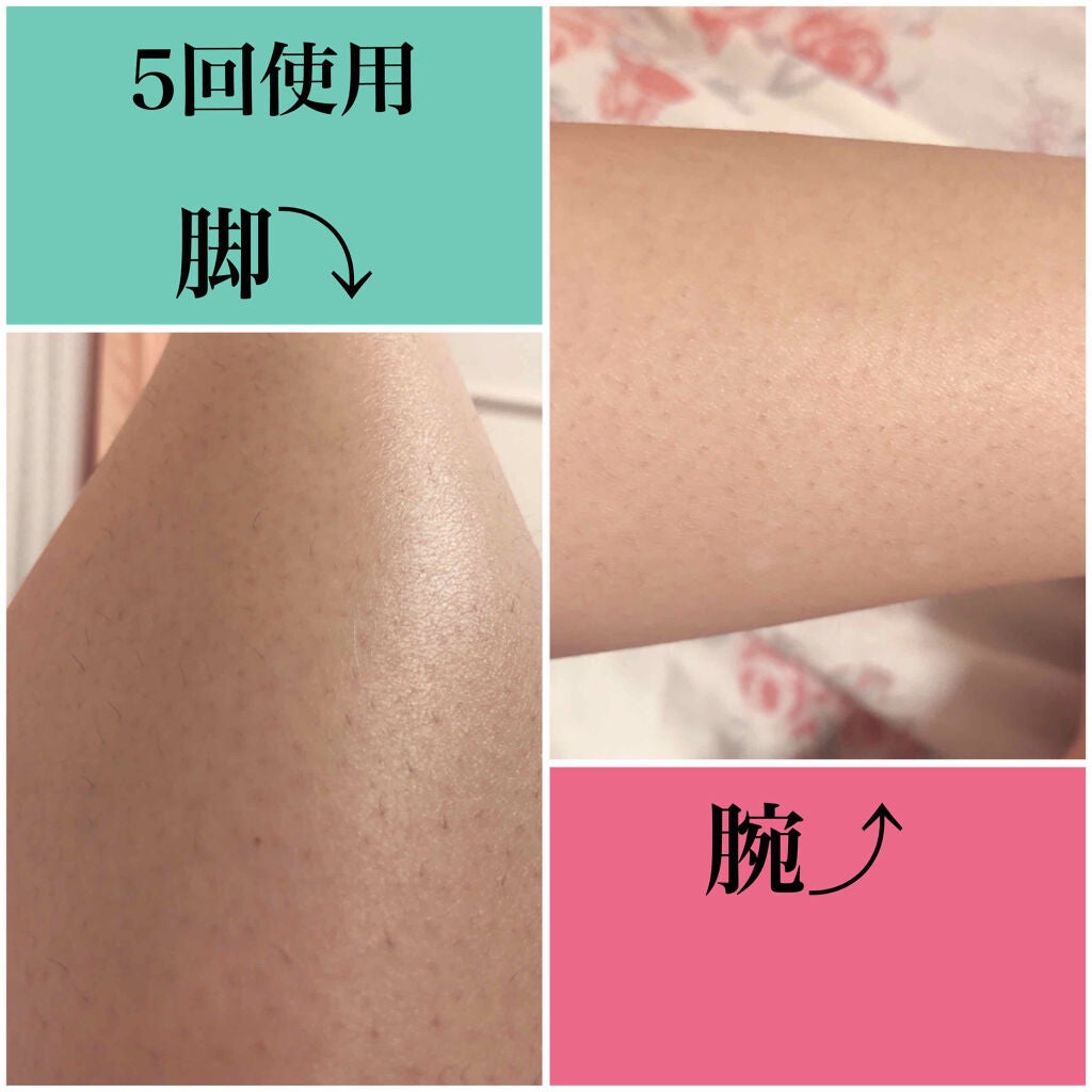 Aminzer IPL光脱毛器/Aminzer/家庭用脱毛器を使ったクチコミ(3枚目)