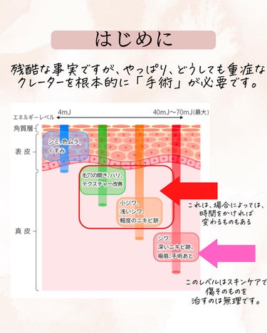 おゆみ|ニキビ・ニキビ跡ケア on LIPS 「@______ohyoume他の投稿はこちらから！【クレーター..」（2枚目）