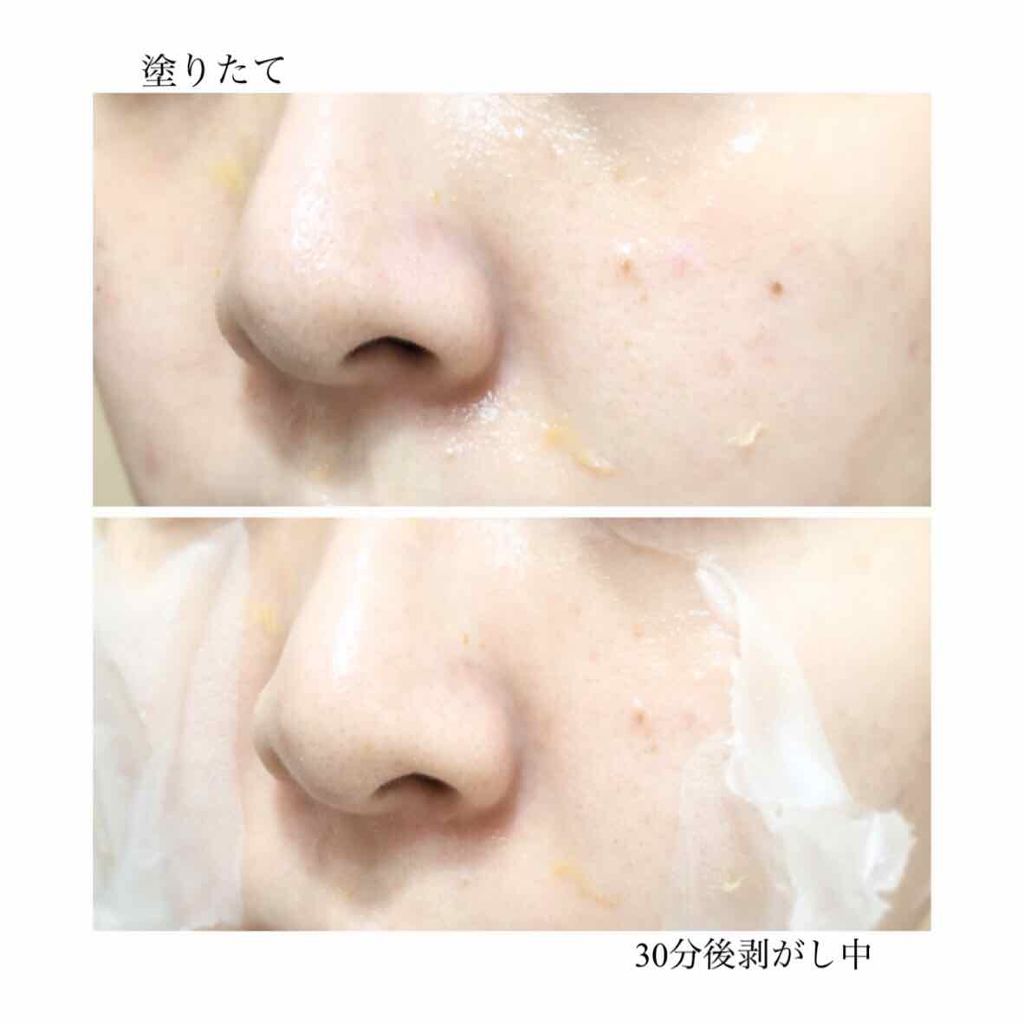 リアルカレンデュラピールオフパック/APRILSKIN/ピーリングを使ったクチコミ(3枚目)