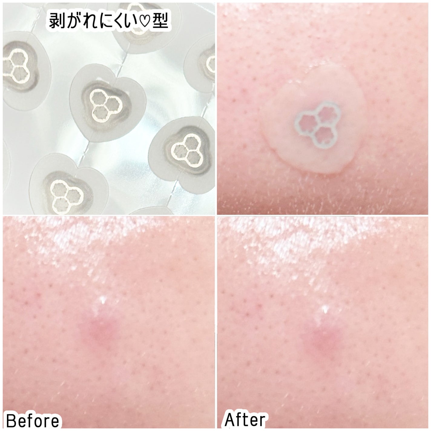 ACマグネシウムパッチ ミニ/スノーツープラス/にきびパッチを使ったクチコミ(4枚目)