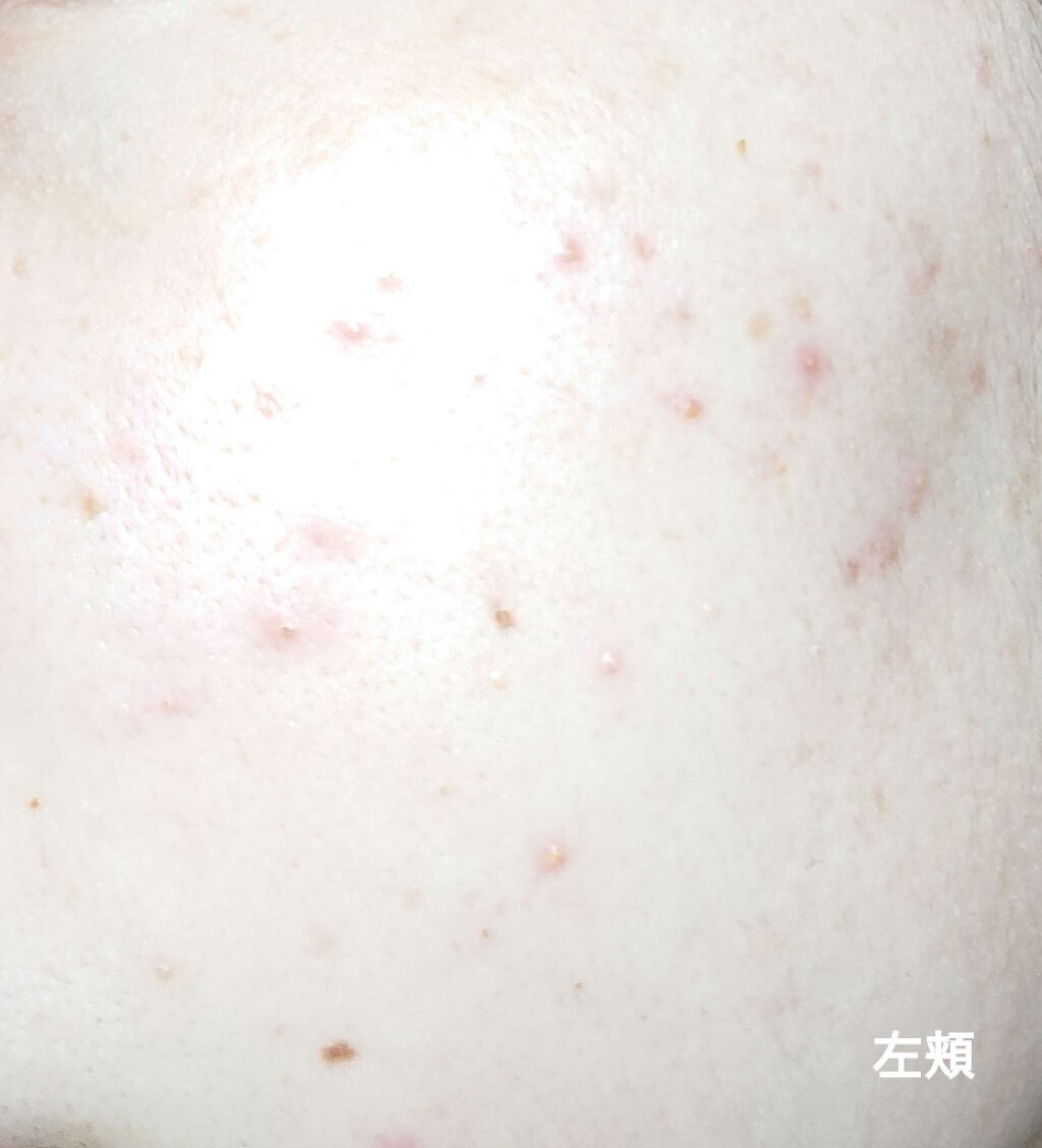 チョコラBBプラス (医薬品)/チョコラBB/その他を使ったクチコミ（2枚目）