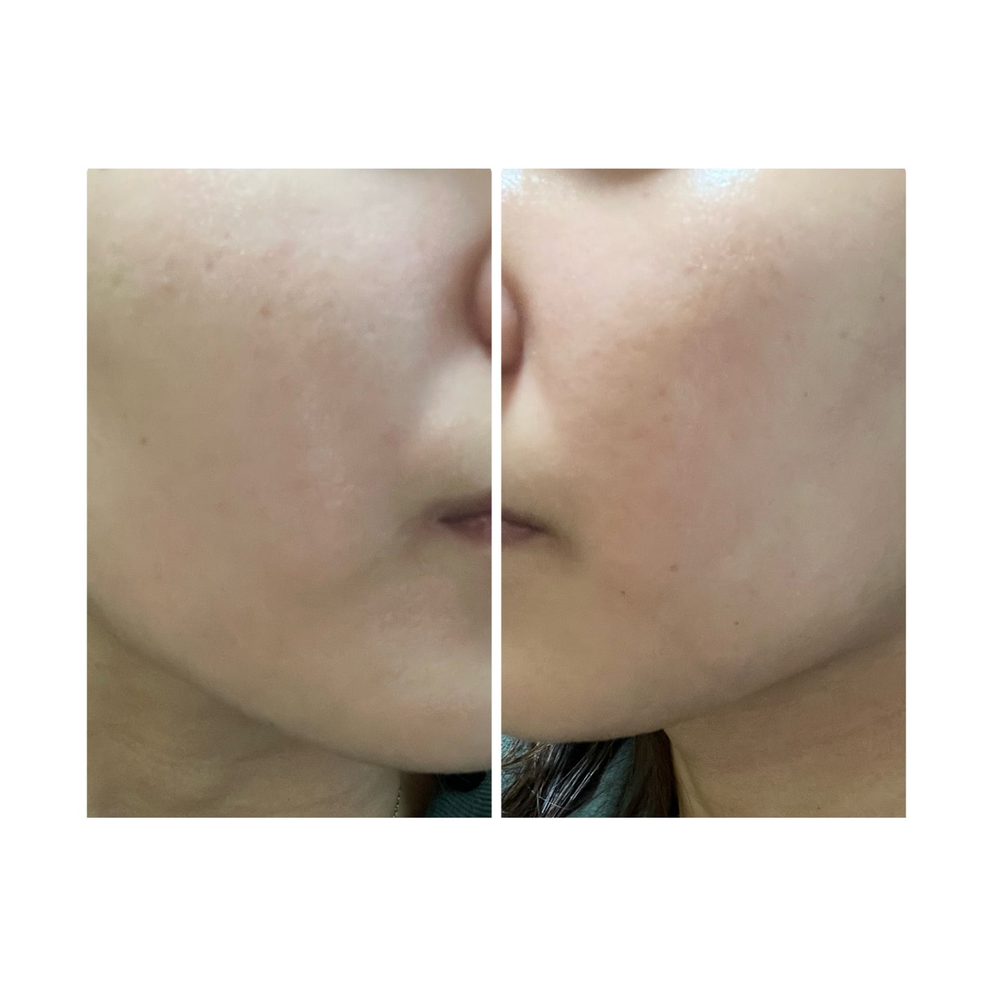 ぽむ on LIPS 「2023.9.13皮膚科に受診 エピデュオとヘパリン処方1枚目..」(1枚目)