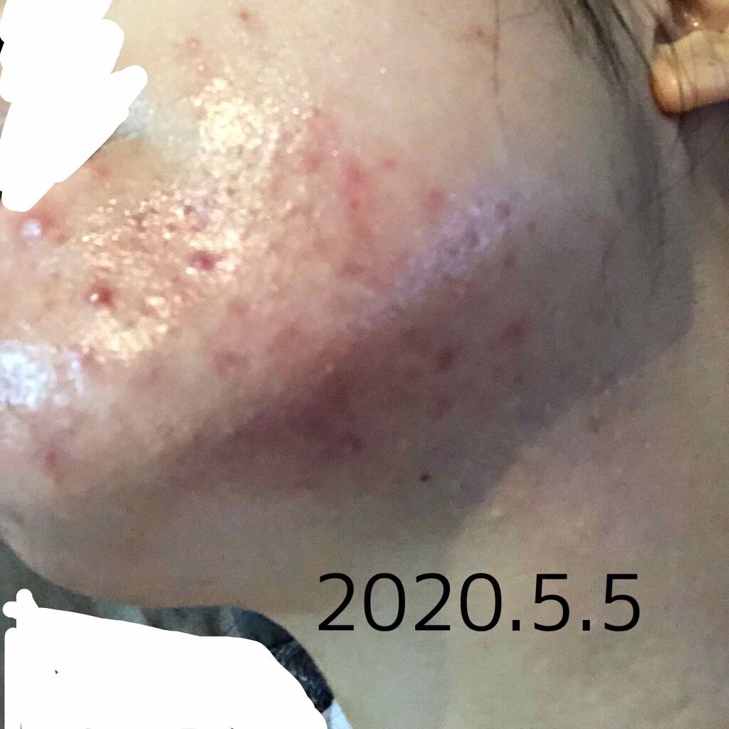 パピコ28世 on LIPS 「ニキビが治ってきて、この喜びを忘れないために、辛かったことを忘..」(3枚目)