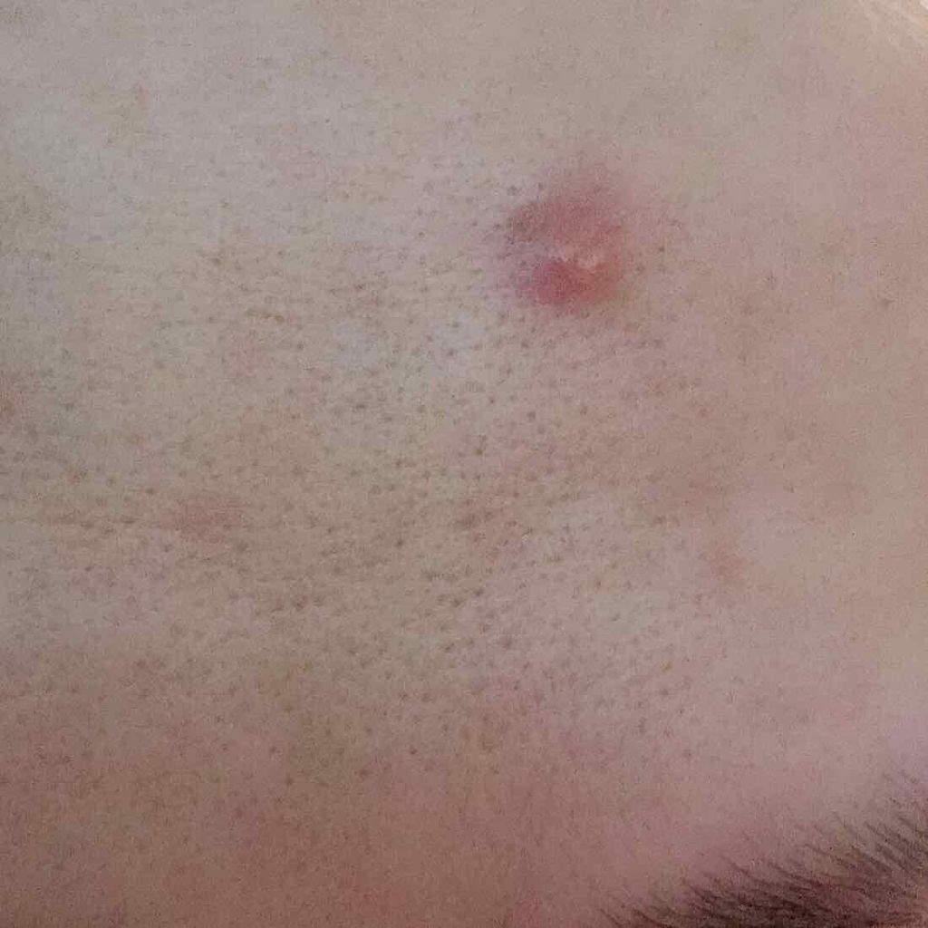 薬用 しみ 集中対策 美容液/メラノCC/美容液を使ったクチコミ（2枚目）