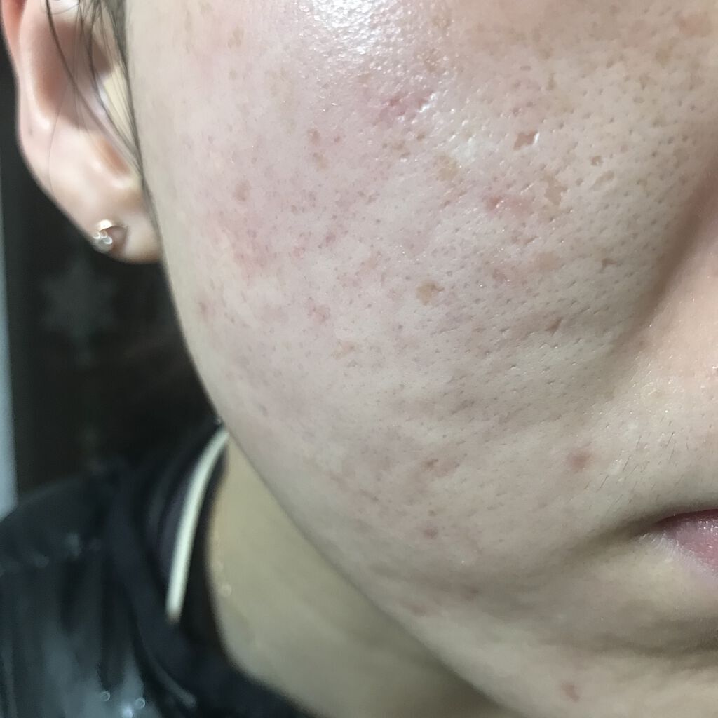 レチノールA 1% アドバンスドリバイタリゼーションクリーム/Life-flo/フェイスクリームを使ったクチコミ（1枚目）