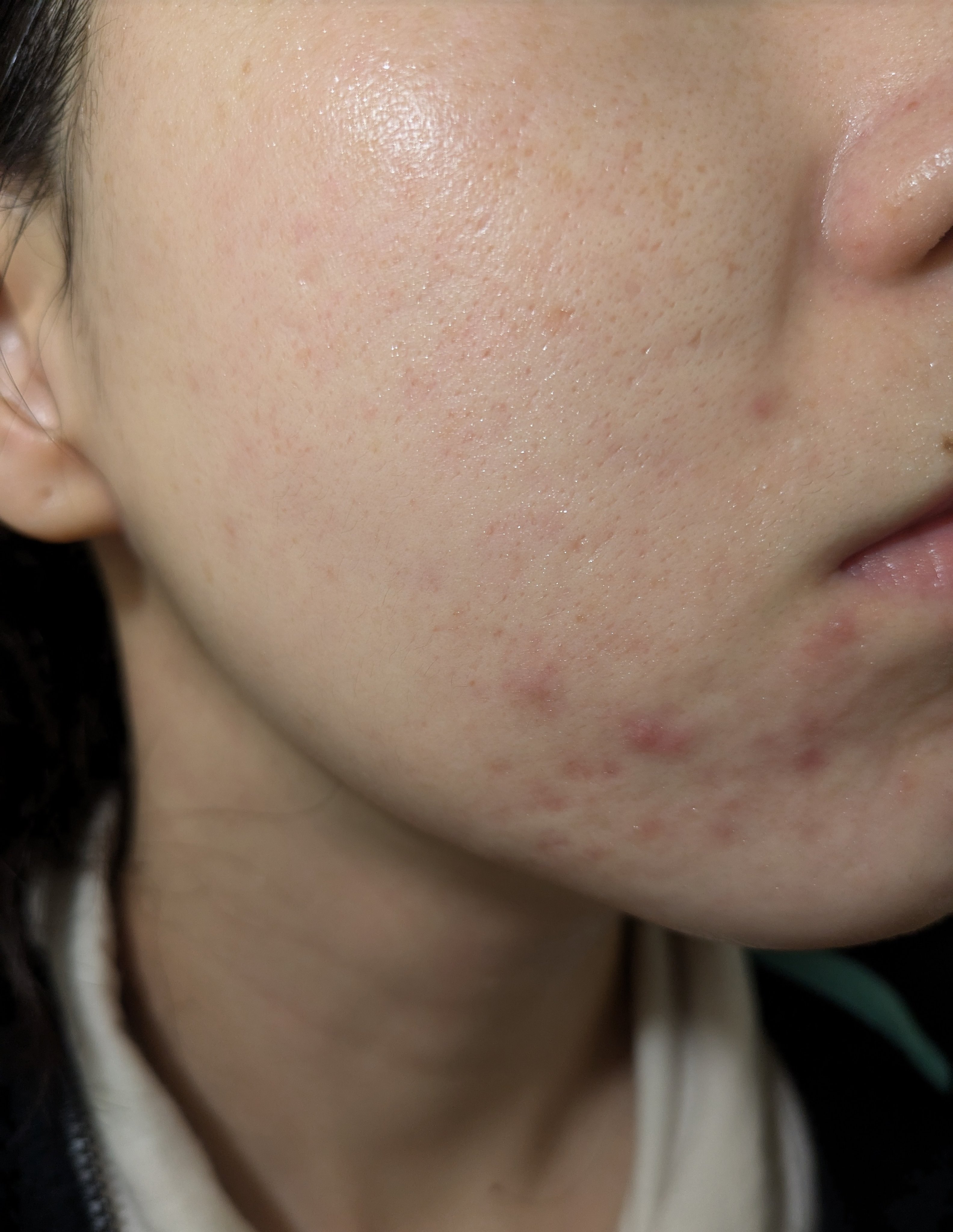 11/11の#汚肌工事録