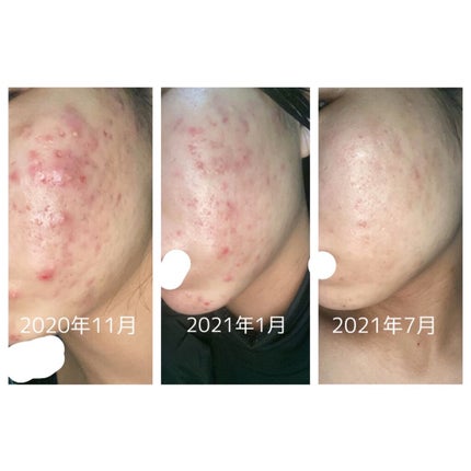 クリアモイスチャー M(しっとりタイプ)/オルビス/乳液を使ったクチコミ(1枚目)