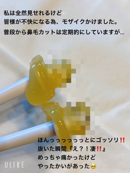 投稿ある方フォロバ100/ コッペ。 on LIPS 「【痛いけど、鼻毛スッキリ&ゴッソリ】セリア 鼻ワックス 鼻毛脱..」(8枚目)