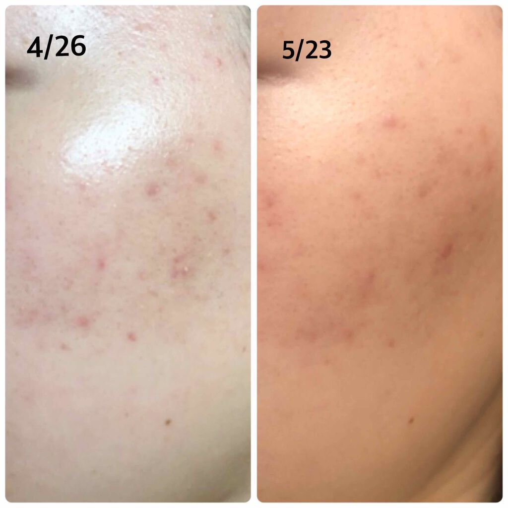 皮脂トラブルケア 保湿ジェル/キュレル/化粧水を使ったクチコミ(3枚目)