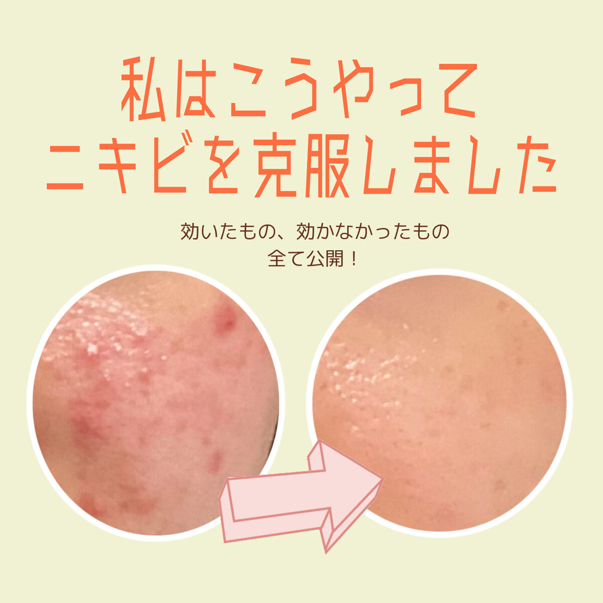 モイストケア エマルジョン MB/d プログラム/乳液を使ったクチコミ（1枚目）