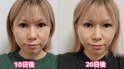 ELFACE/ELFACE/美顔器・マッサージを使ったクチコミ(4枚目)