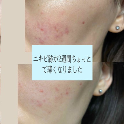 DHC ビタミンCハードカプセル/DHC/美容サプリメントを使ったクチコミ(1枚目)