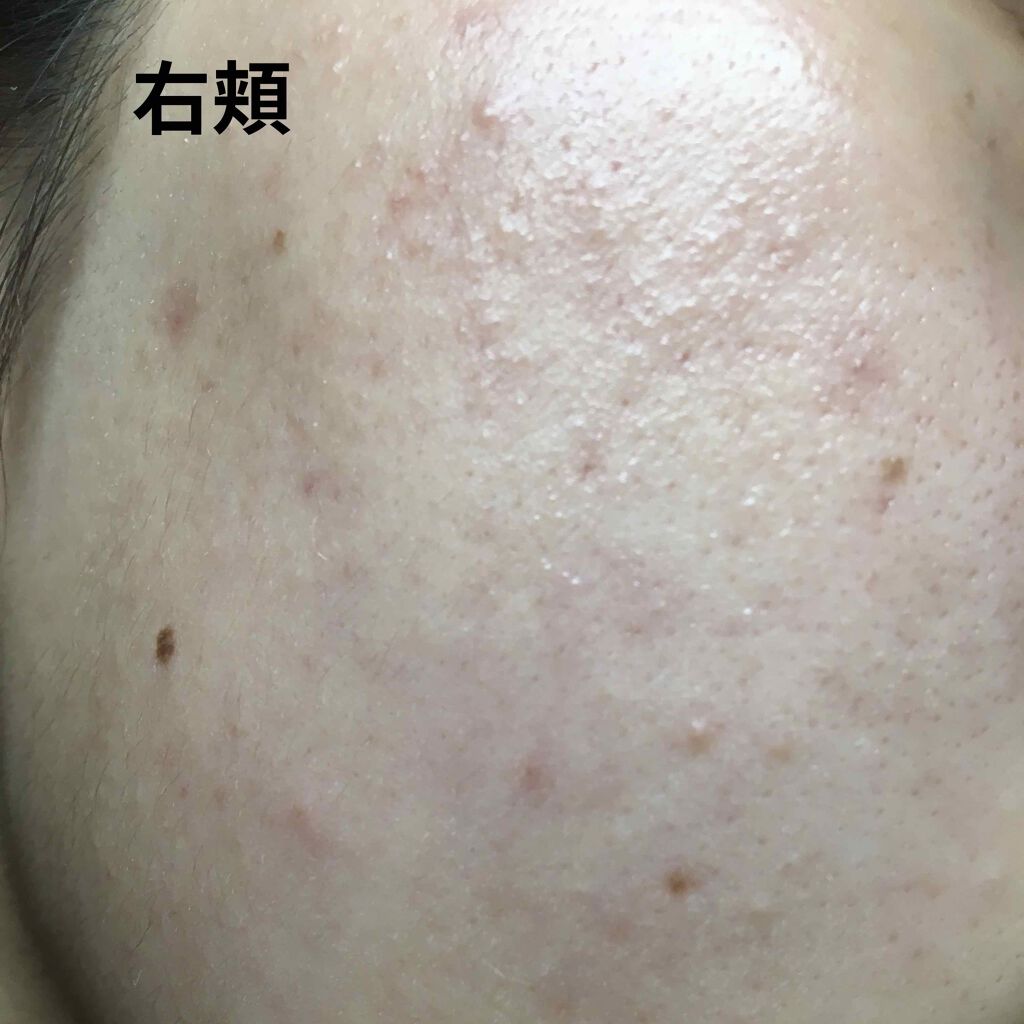 ビーソフテン ローション(医薬品)/持田製薬/その他を使ったクチコミ（3枚目）