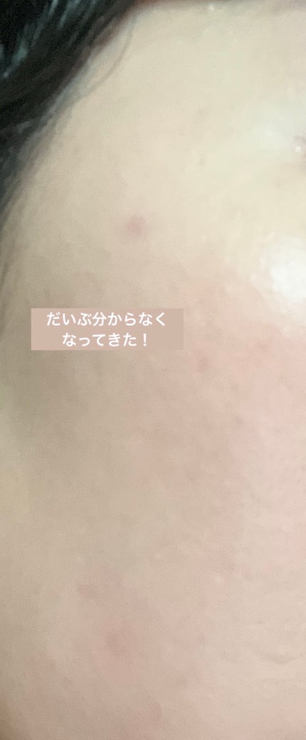 まなな♡ on LIPS 「ニキビ?吹き出物?滅多にできないのですが、突然できました😰少し..」(4枚目)