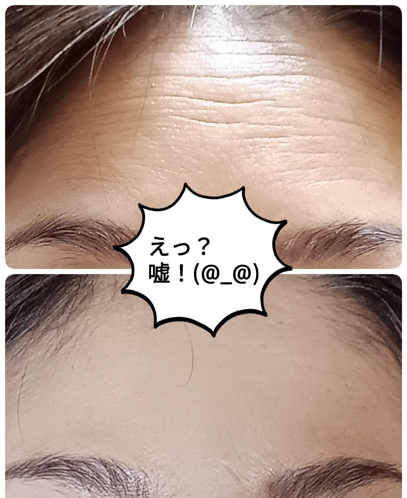 おでこでシワ取りパッチ/株式会社オントリス/その他を使ったクチコミ（2枚目）