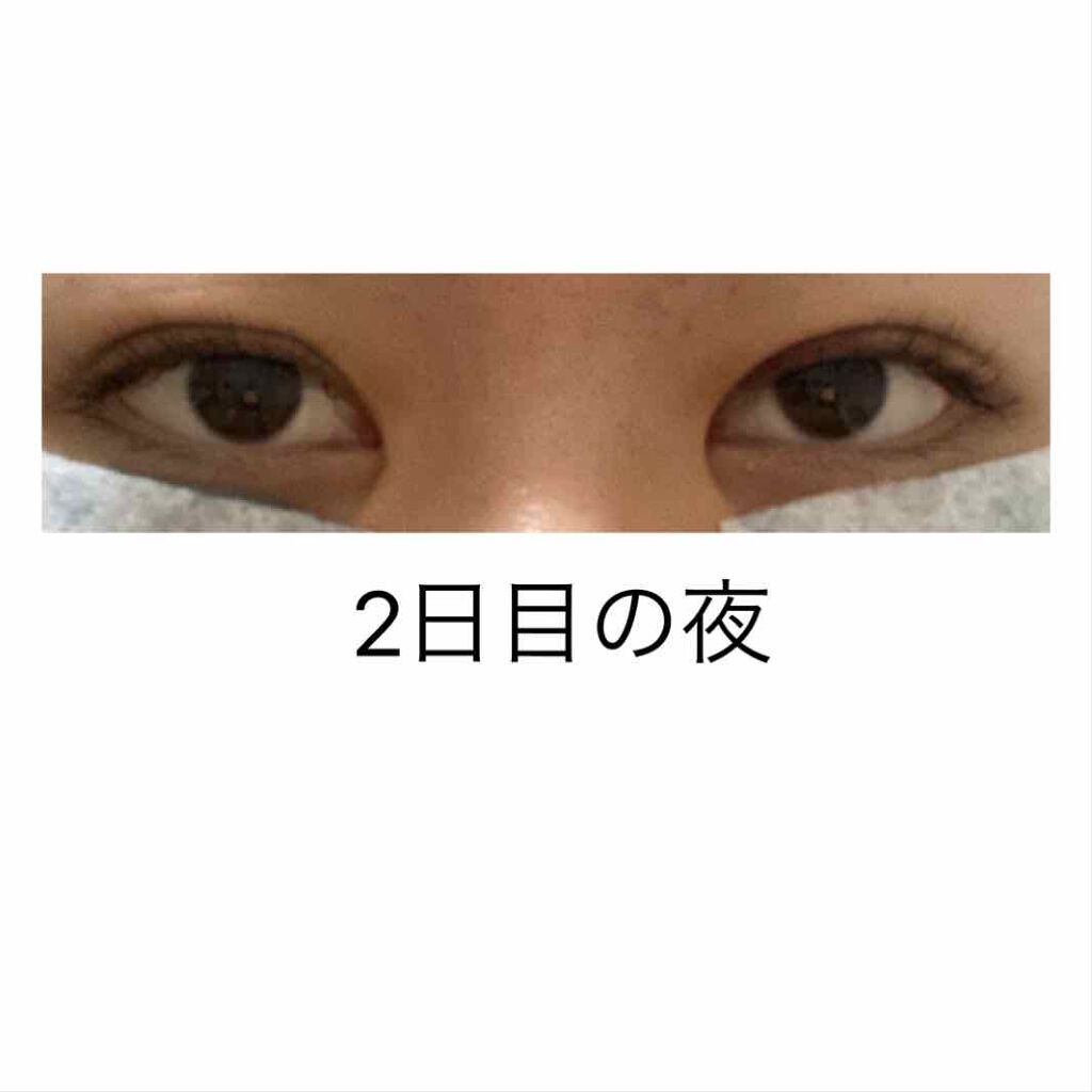 かっこいい女になりたいんだ on LIPS 「2日目の夜腫れは少し落ち着いてきた様子です手術から24時間が経..」(1枚目)