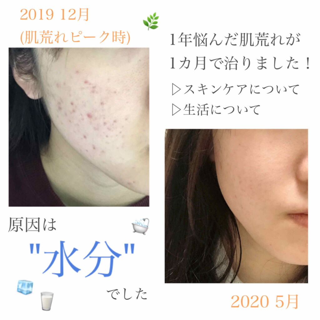 オロナインＨ軟膏 (医薬品)/オロナイン/その他を使ったクチコミ（1枚目）