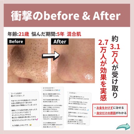 あなたの肌に合ったスキンケア💐コーくん先生 on LIPS 「【もしかしてやってないよね??】コレしてると鼻の黒ずみ一生消え..」(8枚目)